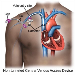 📊Bắt được mảnh gãy Catheter trung tâm sau 10 năm, có nên hay không?